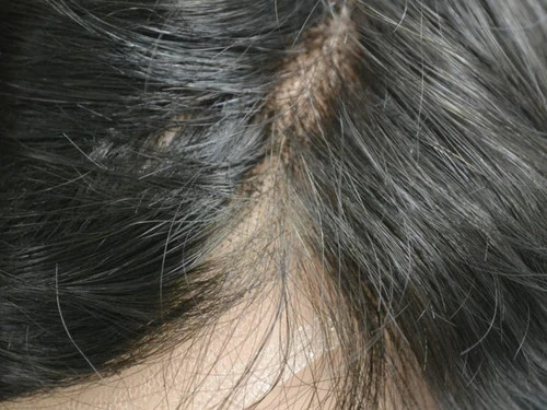 Mens Toupee M105 8"x 10" French Lace Hair System 15 Mens Toupee M105 8"x 10" French Lace Hair System - Image 15